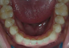 After treatment