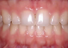 After treatment
