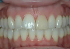 After treatment
